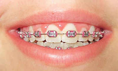 Nasazený plný fixní aparát v horní a dolní čelisti