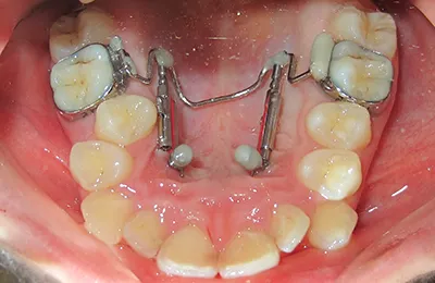 Ukázka distalizačního aparátku