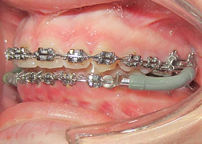 Nasazený fixní funkční aparátek