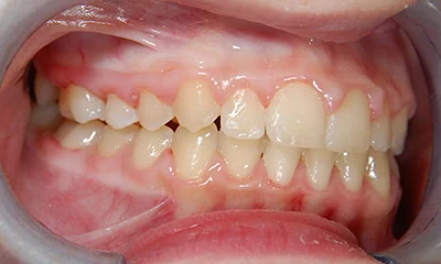 Léčba retinovaného špičáku - po léčbě