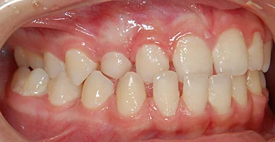 Léčba zákusu a zkříženého skusu - před léčbou