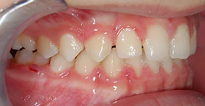 Léčba zákusu a zkříženého skusu - po léčbě